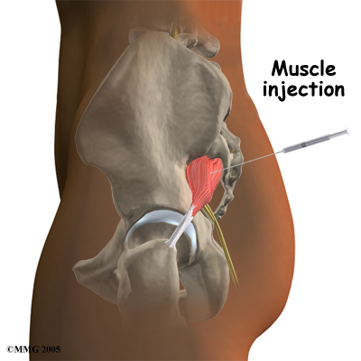 Piriformis Syndrome - South Vancouver Physiotherapy Clinic