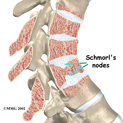 Physiotherapy in Sidney for Scheuermann s Disease