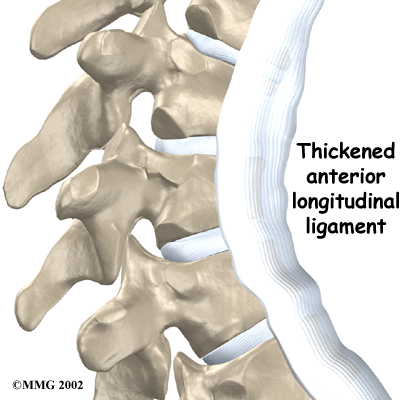 Physiotherapy in Sidney for Scheuermann s Disease